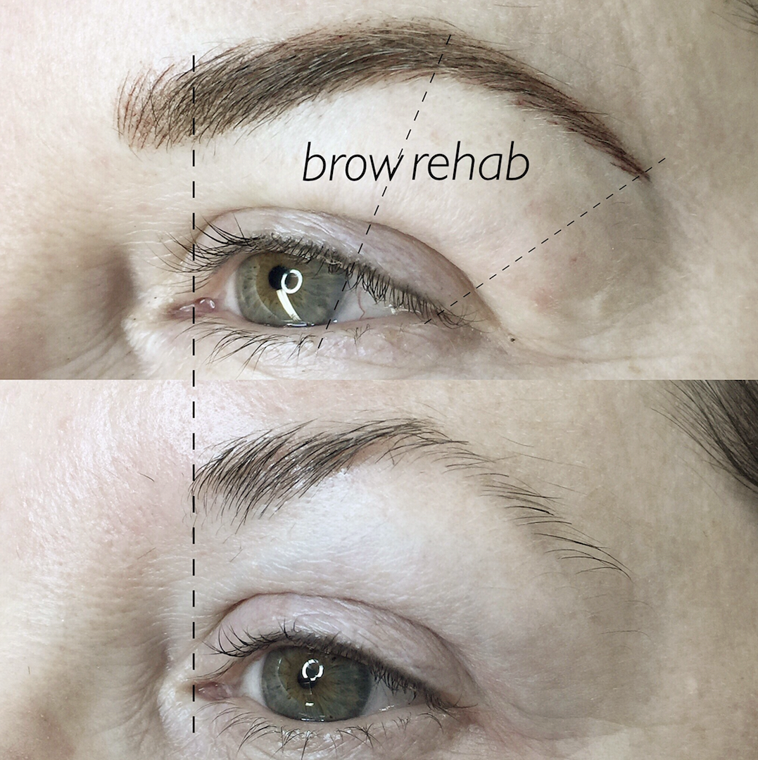 Brow-Rehab.png